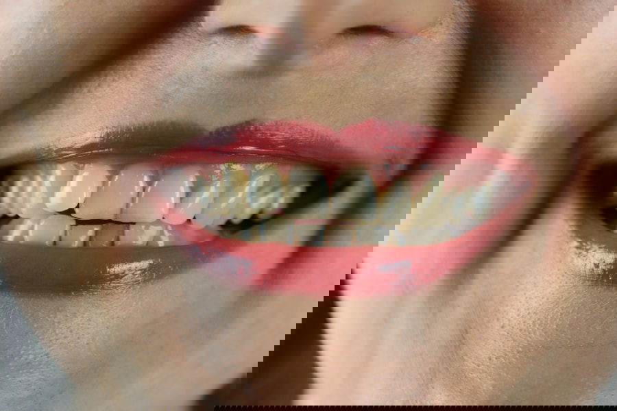 Photo Dental veneers vs dental crowns