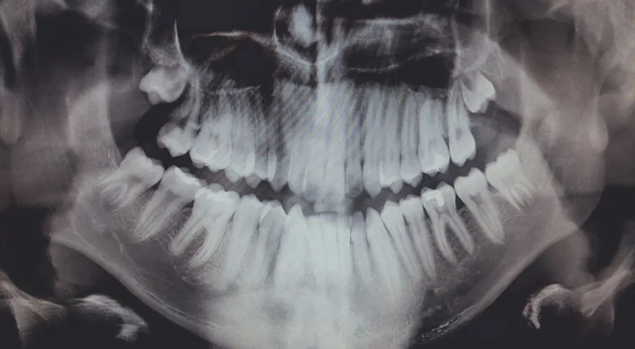 Photo Wisdom Teeth Removal