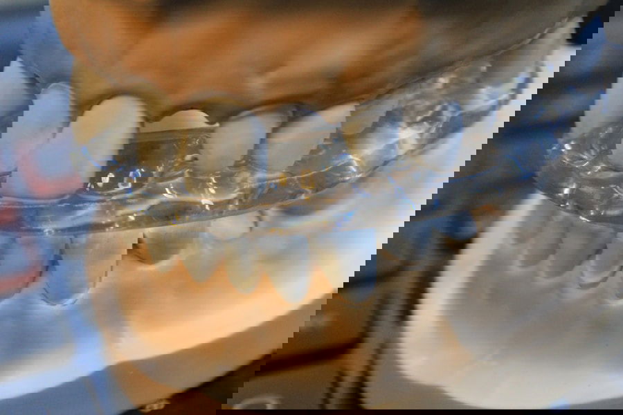 Photo Dental veneers for chipped teeth