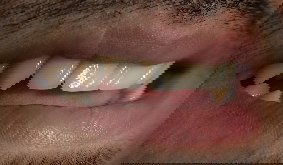 teeth whitening reviews