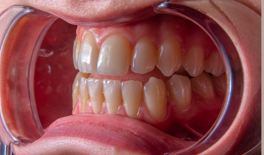Photo Sensitive gums