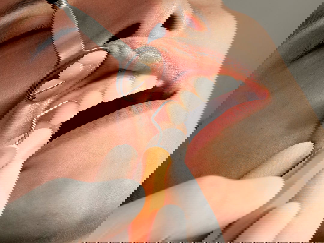 Photo Oral numbing gel