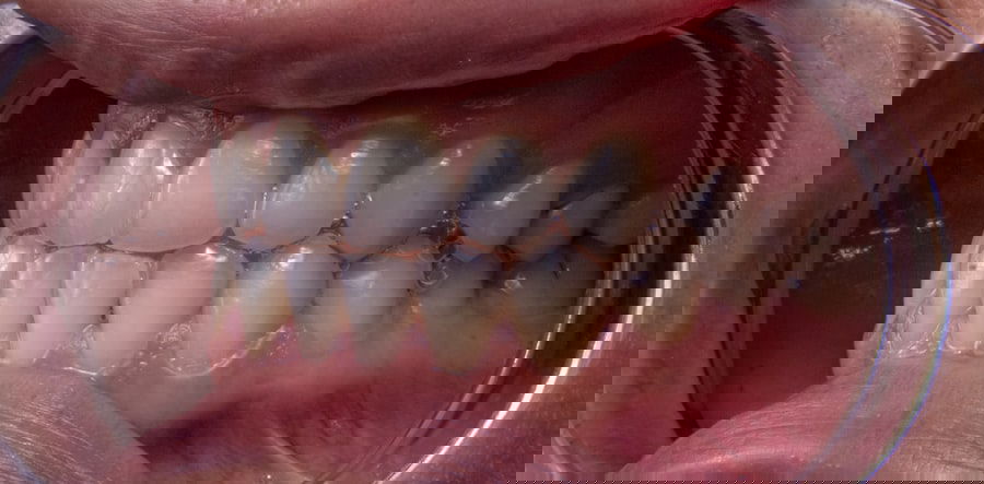 Photo teeth whitening reviews