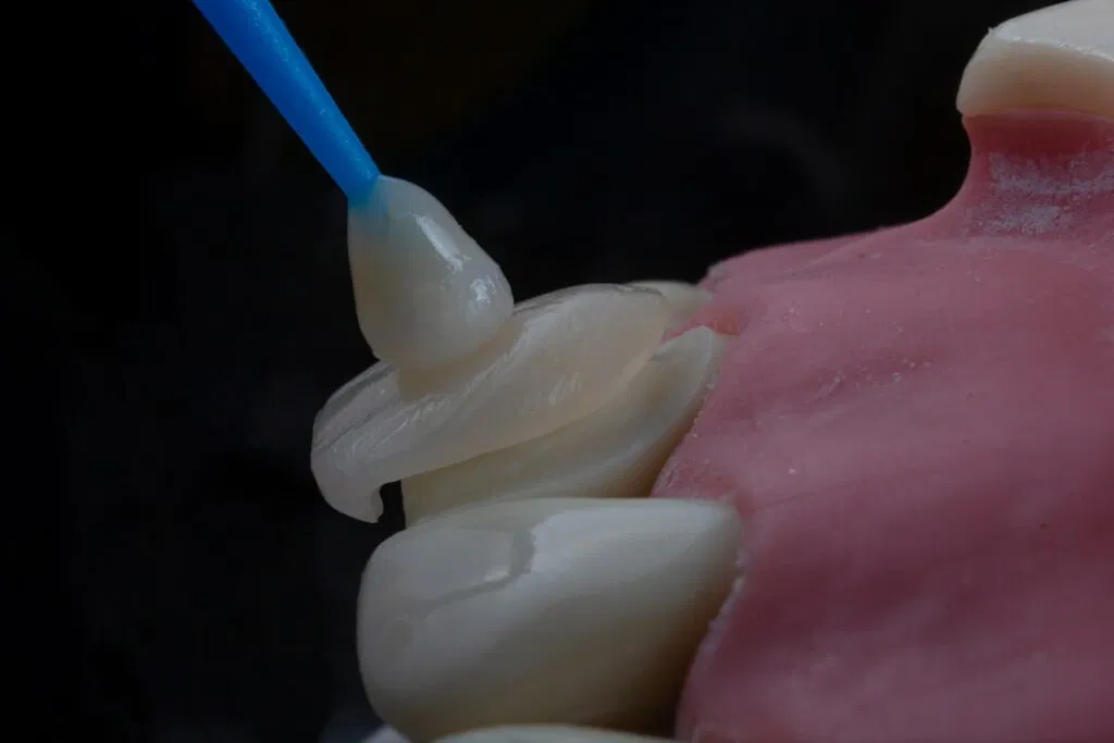 Photo Denture Implants