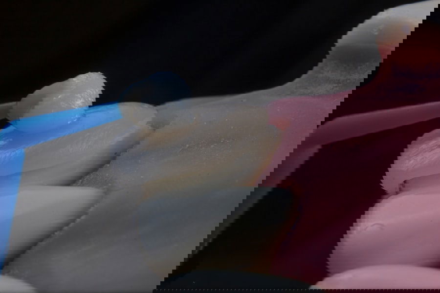 Photo Denture Implants