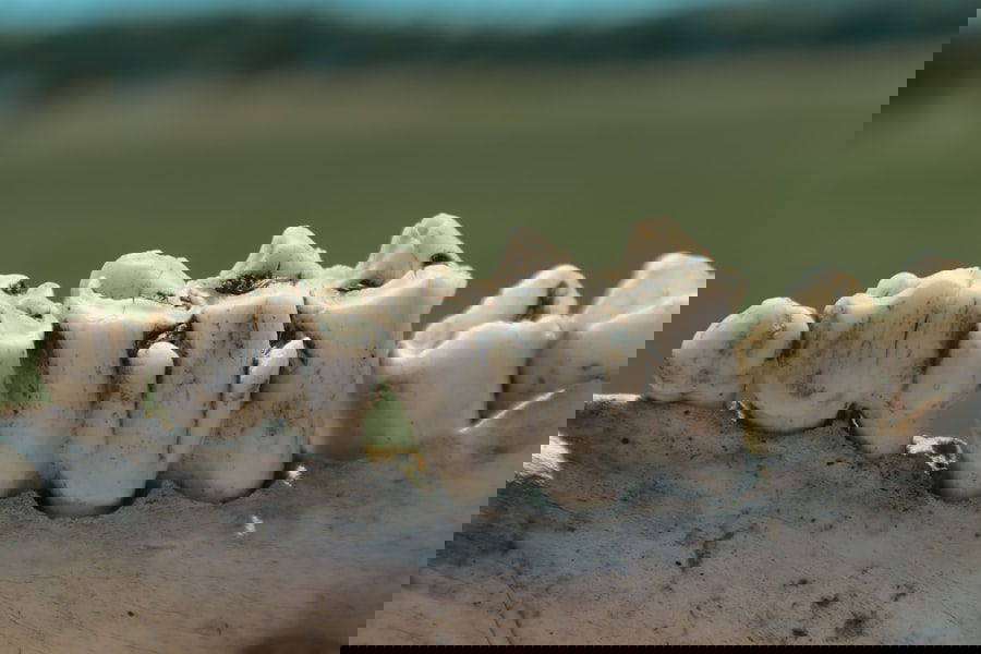 Denture Alternatives