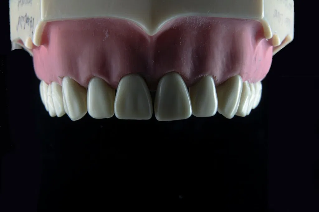 Photo Denture Alternatives