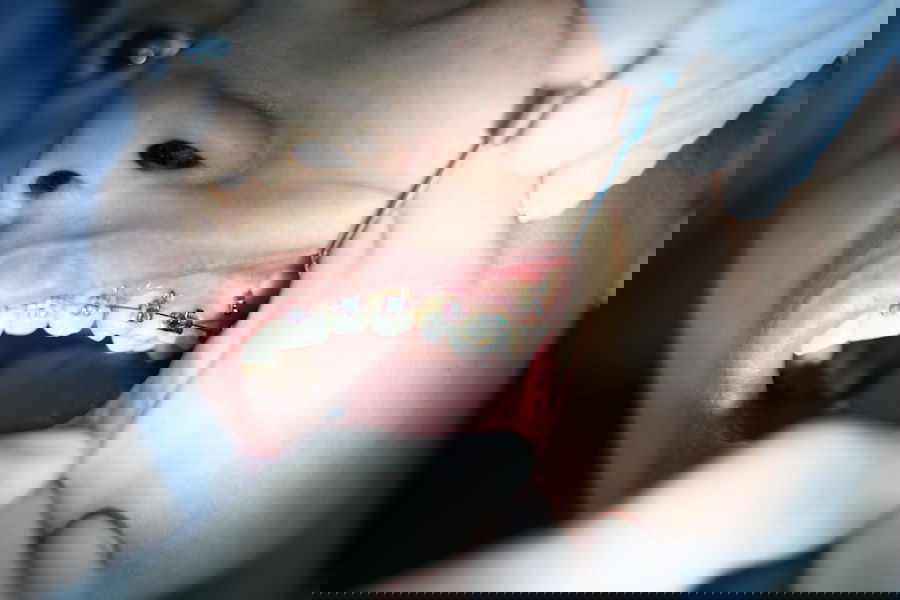 Photo Denture Alternatives