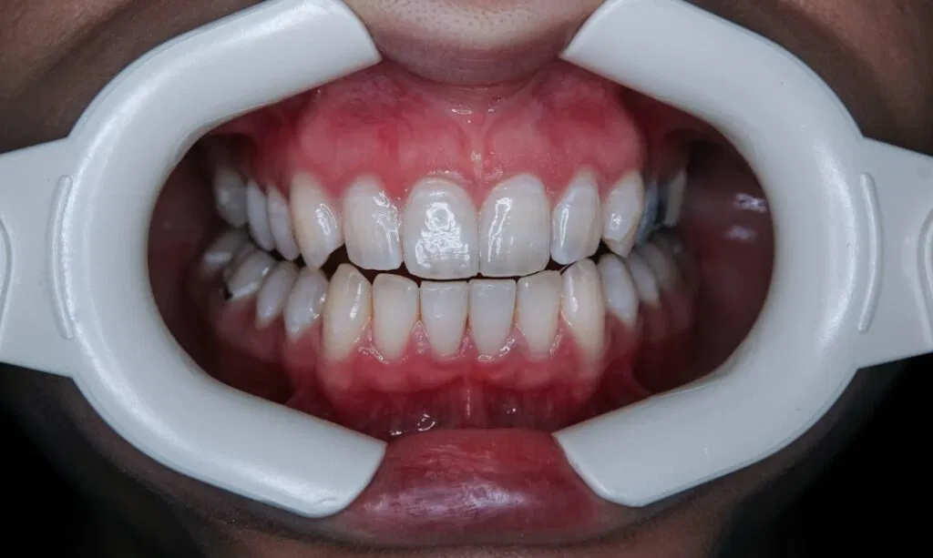 Photo Denture Problems