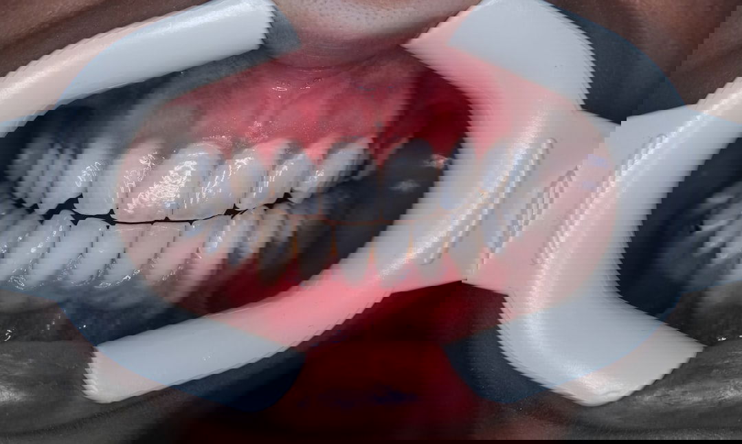 Photo Denture Problems